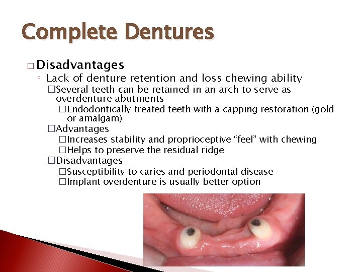 Complete Dentures � Disadvantages ◦ Lack of denture retention and loss chewing ability �Several