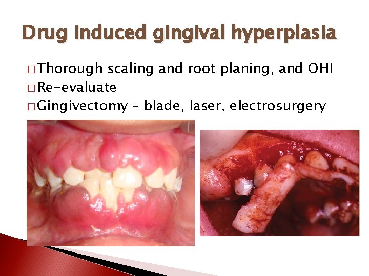 Drug induced gingival hyperplasia � Thorough scaling and root planing, and OHI � Re-evaluate
