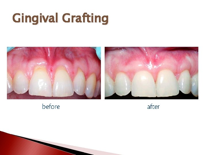 Gingival Grafting 