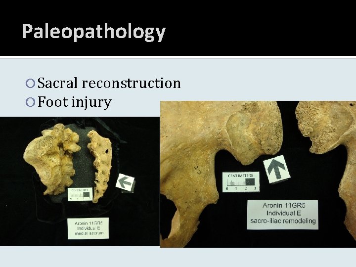 Paleopathology Sacral reconstruction Foot injury 