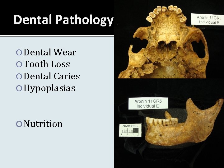 Dental Pathology Dental Wear Tooth Loss Dental Caries Hypoplasias Nutrition 