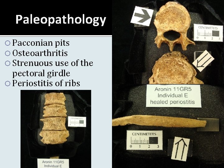 Paleopathology Pacconian pits Osteoarthritis Strenuous use of the pectoral girdle Periostitis of ribs 