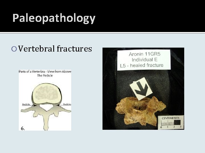 Paleopathology Vertebral fractures 6. 