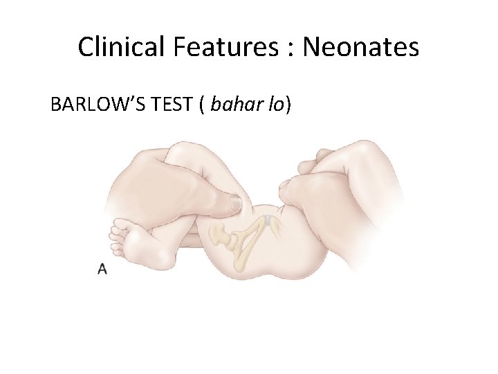 Clinical Features : Neonates BARLOW’S TEST ( bahar lo) 