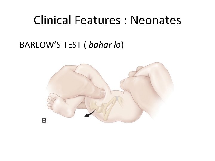 Clinical Features : Neonates BARLOW’S TEST ( bahar lo) 