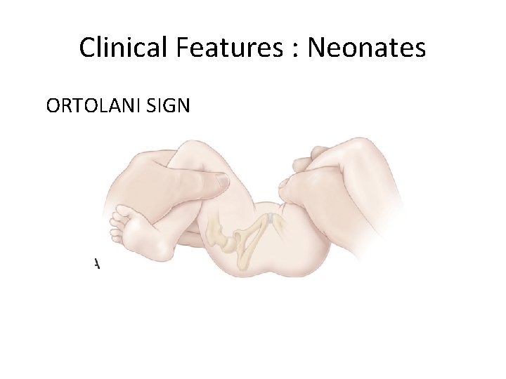 Clinical Features : Neonates ORTOLANI SIGN 