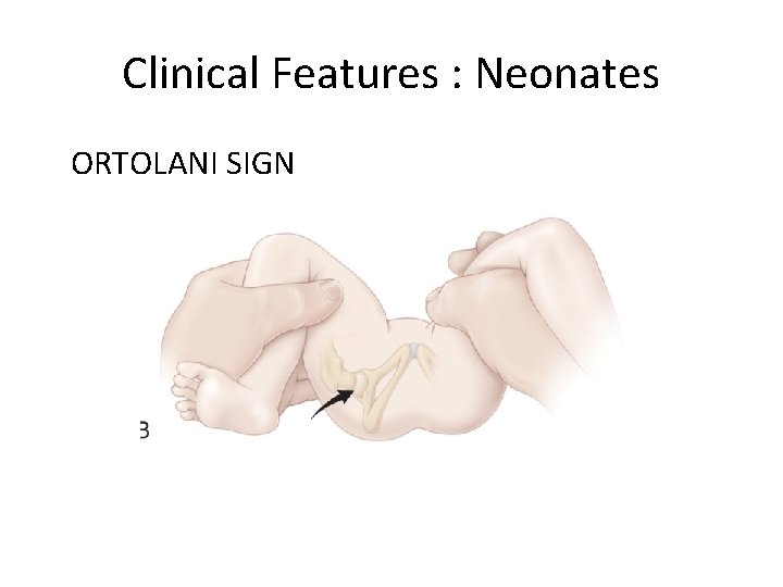 Clinical Features : Neonates ORTOLANI SIGN 