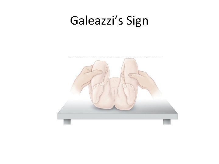 Galeazzi’s Sign 