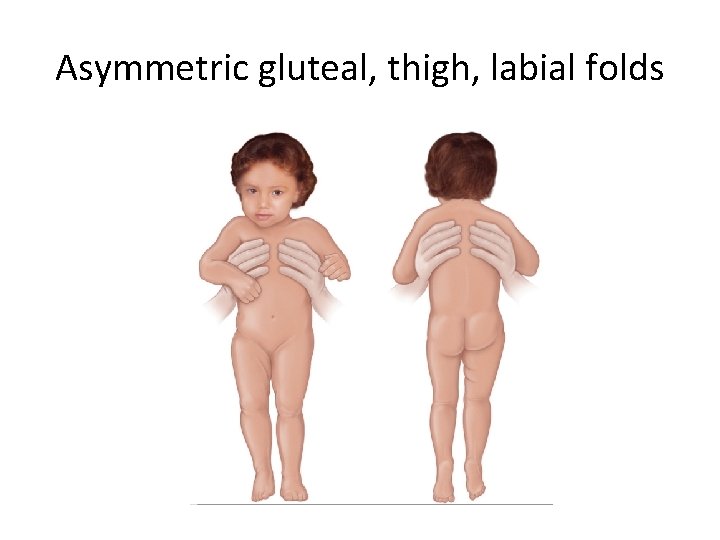 Asymmetric gluteal, thigh, labial folds 