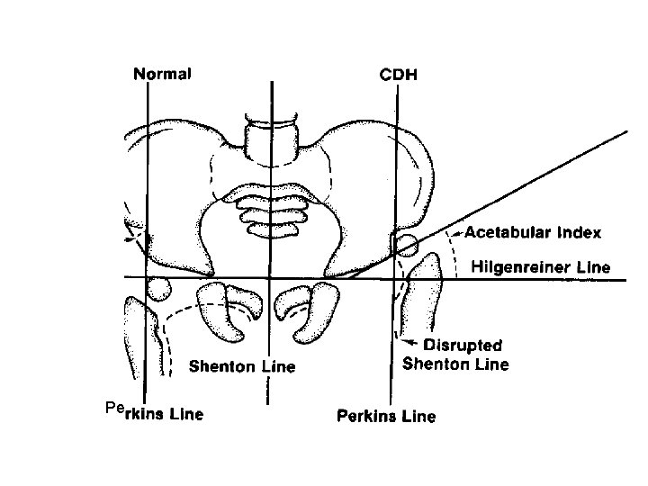 Developmental Dysplasia Of The Hip DDH Definition Dysplasia Developmental Dysplasia Of The Hip DDH Definition Dysplasia