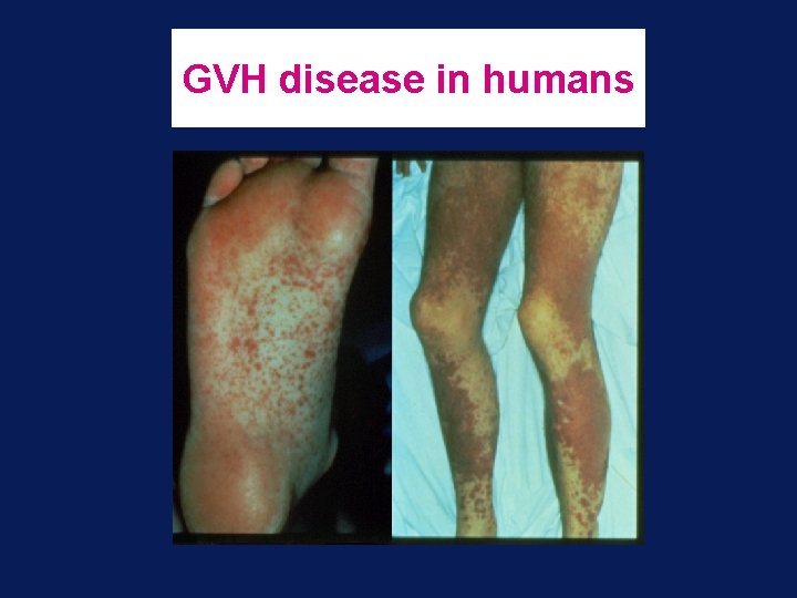 GVH disease in humans 