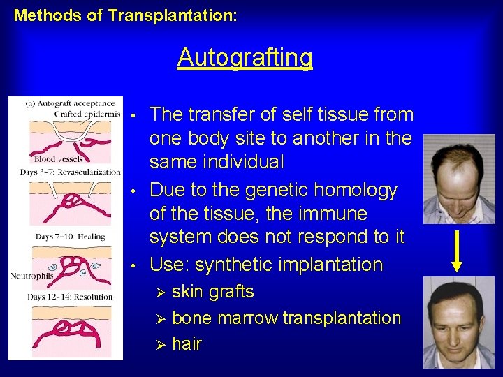 Methods of Transplantation: Autografting • • • The transfer of self tissue from one