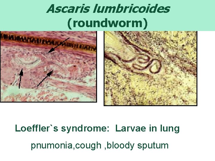 ascaris bronchitis)