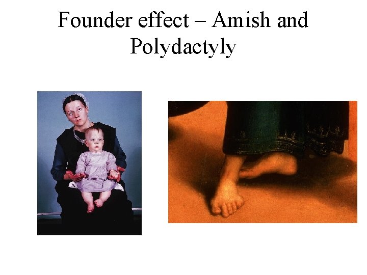 Founder effect – Amish and Polydactyly 
