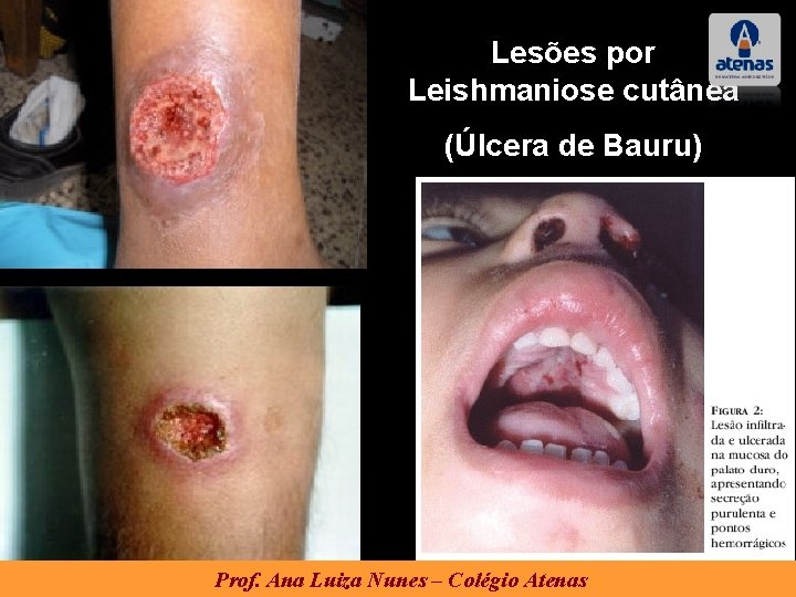 Lesões por Leishmaniose cutânea (Úlcera de Bauru) Prof. Ana Luiza Nunes – Colégio Atenas Lesões por Leishmaniose cutânea (Úlcera de Bauru) Prof. Ana Luiza Nunes – Colégio Atenas