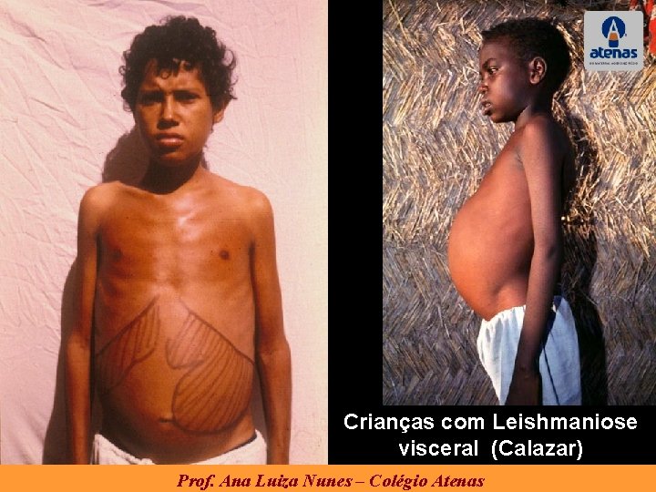 Crianças com Leishmaniose visceral (Calazar) Prof. Ana Luiza Nunes – Colégio Atenas Crianças com Leishmaniose visceral (Calazar) Prof. Ana Luiza Nunes – Colégio Atenas