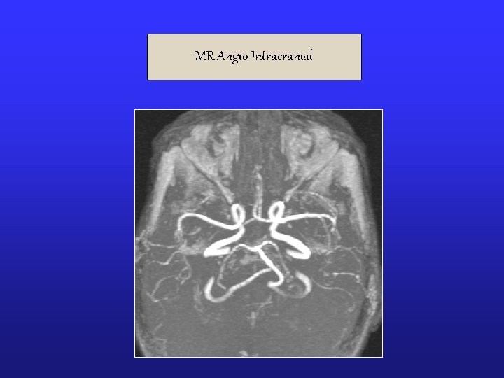 MR Angio Intracranial 