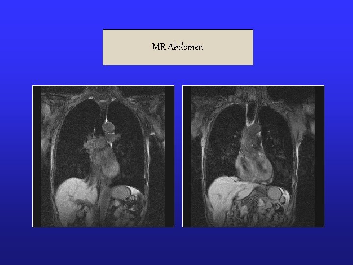 MR Abdomen MR Abdomen