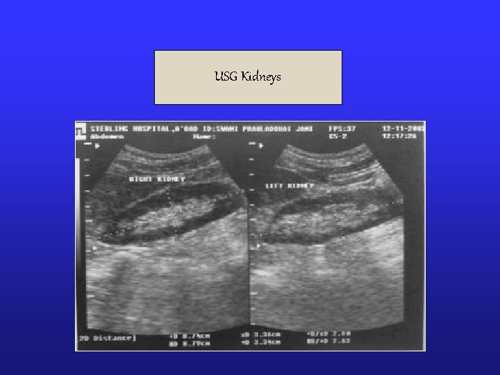 USG Kidneys 