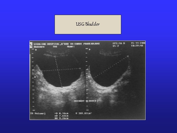 USG Bladder 