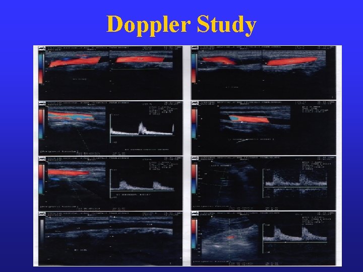 Doppler Study 