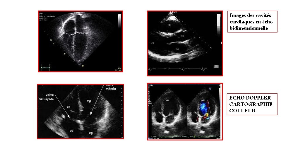 Images des cavités cardiaques en écho bidimensionnelle ECHO DOPPLER CARTOGRAPHIE COULEUR 