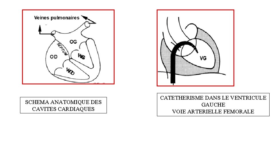 SCHEMA ANATOMIQUE DES CAVITES CARDIAQUES CATETHERISME DANS LE VENTRICULE GAUCHE VOIE ARTERIELLE FEMORALE 