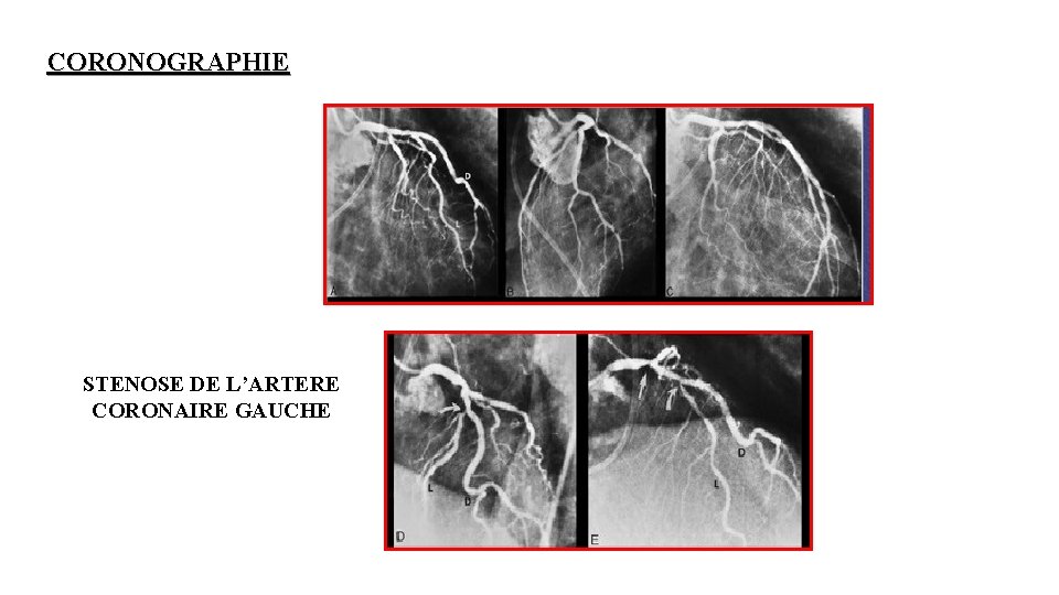 CORONOGRAPHIE STENOSE DE L’ARTERE CORONAIRE GAUCHE 