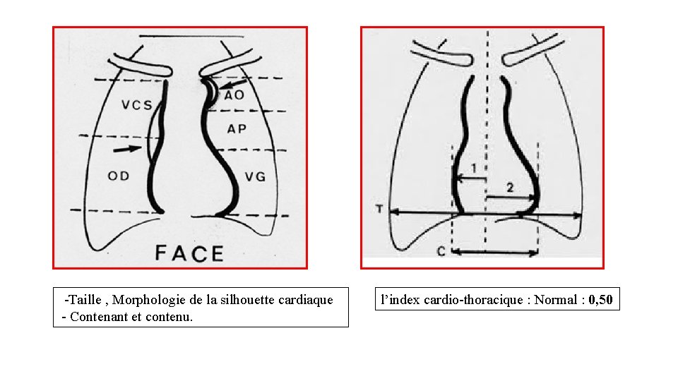  -Taille , Morphologie de la silhouette cardiaque - Contenant et contenu. l’index cardio-thoracique