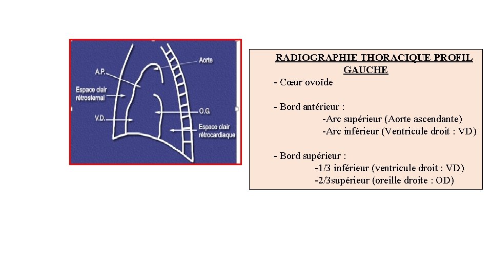 RADIOGRAPHIE THORACIQUE PROFIL GAUCHE - Cœur ovoïde - Bord antérieur : -Arc supérieur (Aorte