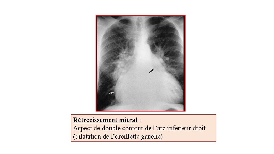 Rétrécissement mitral : Aspect de double contour de l’arc inférieur droit (dilatation de l’oreillette