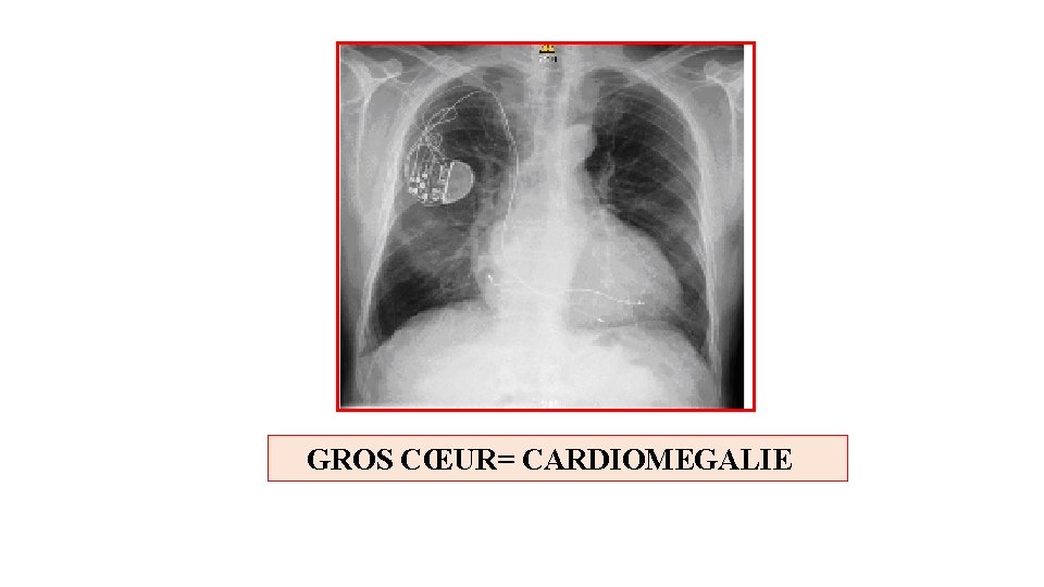  GROS CŒUR= CARDIOMEGALIE 