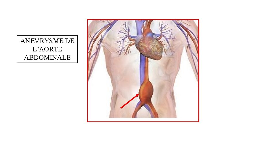 ANEVRYSME DE L’AORTE ABDOMINALE 
