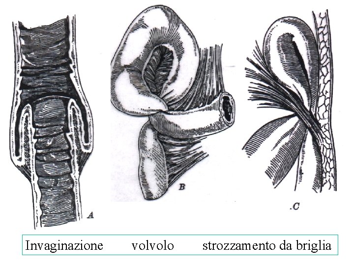 Invaginazione volvolo strozzamento da briglia 