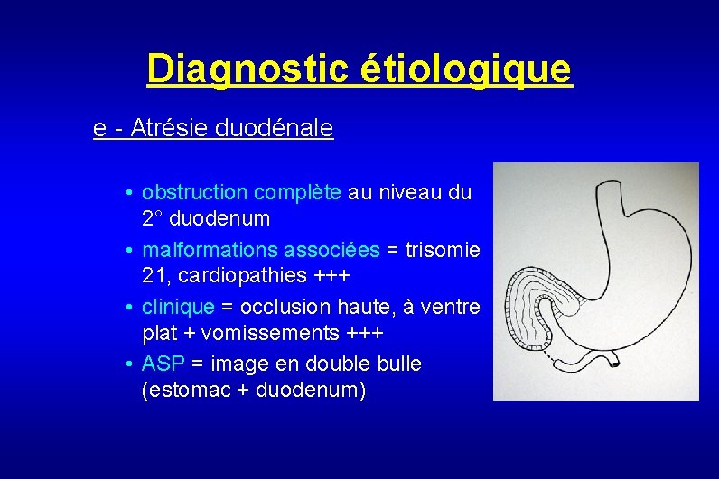 Diagnostic étiologique e - Atrésie duodénale • obstruction complète au niveau du 2° duodenum