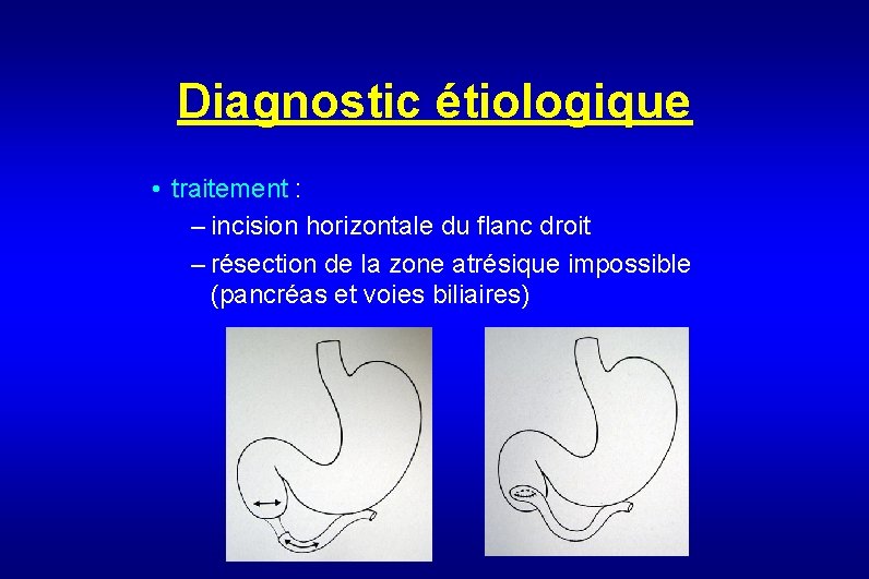 Diagnostic étiologique • traitement : – incision horizontale du flanc droit – résection de