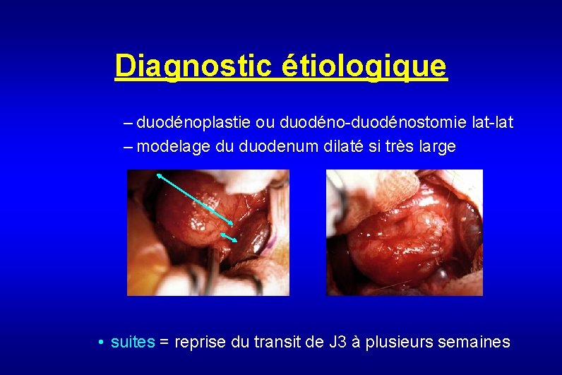 Diagnostic étiologique – duodénoplastie ou duodéno-duodénostomie lat-lat – modelage du duodenum dilaté si très