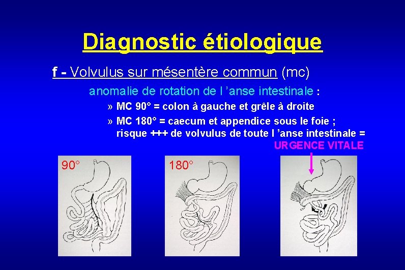 Diagnostic étiologique f - Volvulus sur mésentère commun (mc) anomalie de rotation de l