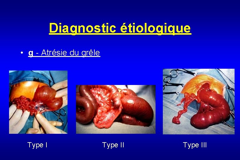 Diagnostic étiologique • g - Atrésie du grêle Type III 