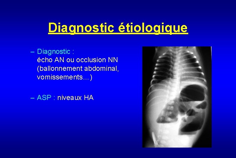 Diagnostic étiologique – Diagnostic : écho AN ou occlusion NN (ballonnement abdominal, vomissements…) –