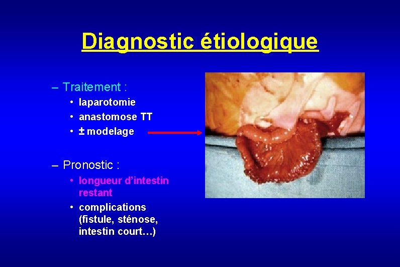 Diagnostic étiologique – Traitement : • laparotomie • anastomose TT • ± modelage –