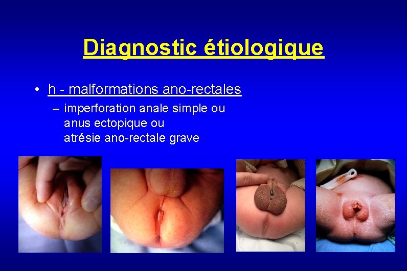 Diagnostic étiologique • h - malformations ano-rectales – imperforation anale simple ou anus ectopique