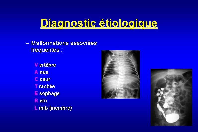 Diagnostic étiologique – Malformations associées fréquentes : V ertèbre A nus C oeur T