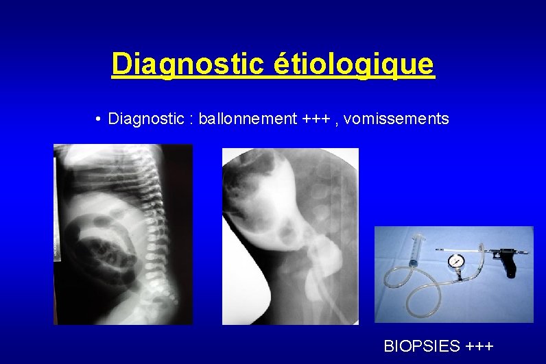 Diagnostic étiologique • Diagnostic : ballonnement +++ , vomissements BIOPSIES +++ 