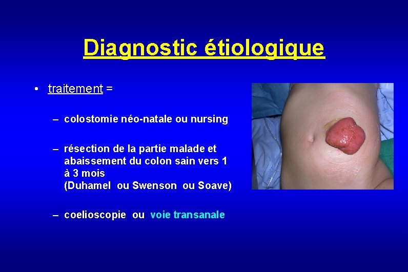 Diagnostic étiologique • traitement = – colostomie néo-natale ou nursing – résection de la