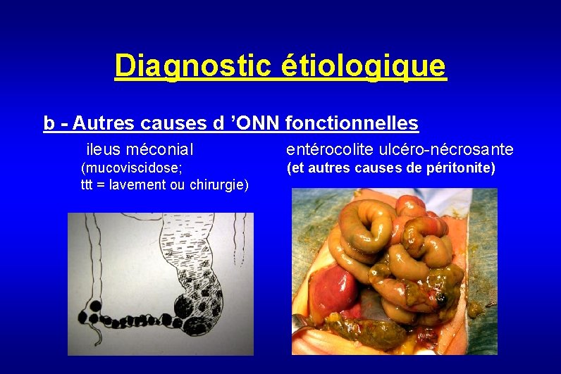 Diagnostic étiologique b - Autres causes d ’ONN fonctionnelles ileus méconial entérocolite ulcéro-nécrosante (mucoviscidose;
