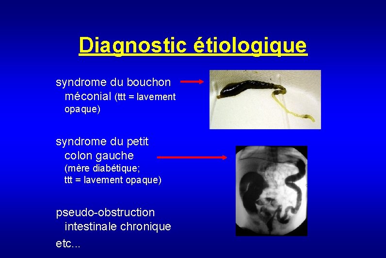 Diagnostic étiologique syndrome du bouchon méconial (ttt = lavement opaque) syndrome du petit colon