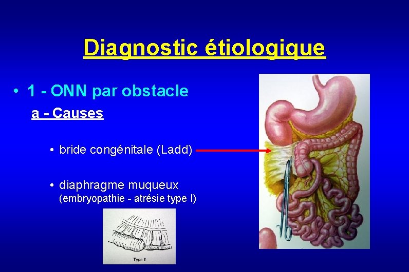 Diagnostic étiologique • 1 - ONN par obstacle a - Causes • bride congénitale