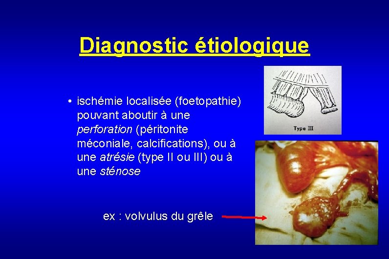 Diagnostic étiologique • ischémie localisée (foetopathie) pouvant aboutir à une perforation (péritonite méconiale, calcifications),