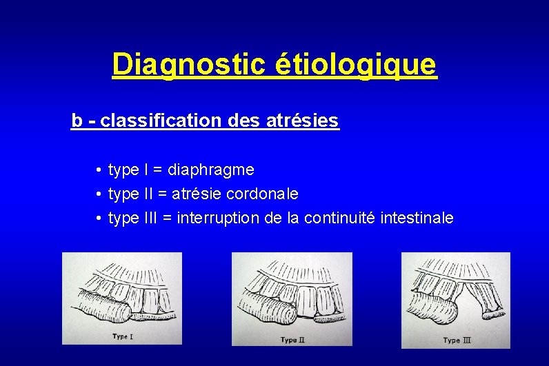 Diagnostic étiologique b - classification des atrésies • type I = diaphragme • type